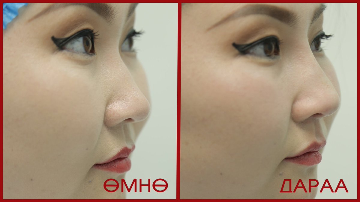 goosaihan2's tweet photo. Бүсгүйчүүдийнхээ уруул хамрыг ингэж гоё болгон доо. Манай эмнэлэг орчин үеийн өндөр үр дүн бүхий аппарат, бусад гоо сайхны үйлчилгээг нэвтрүүлсээр байна. Утас 77186666 https://t.co/4BzvlgdbsY