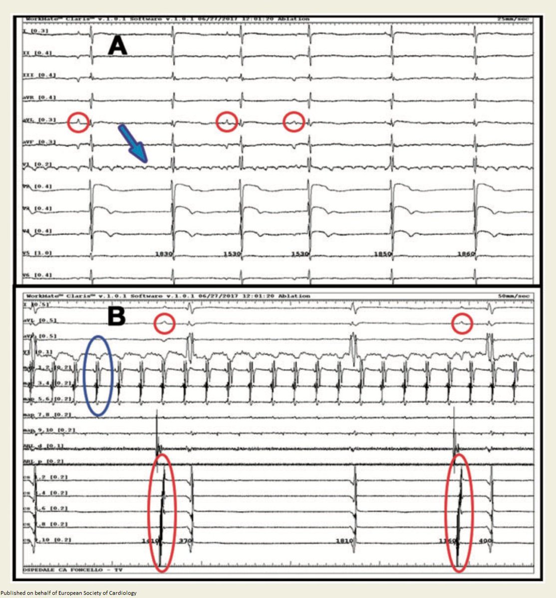 Interatrial electrical dissociation: when the left atrium does not know what the right atrium is doing bit.ly/2PVNIuw

<a href="/escardio/">European Society of Cardiology</a> #Europace #EHRA_ESC #ESCCoT #ESCardioEd #CardioTwitter #freeaccess