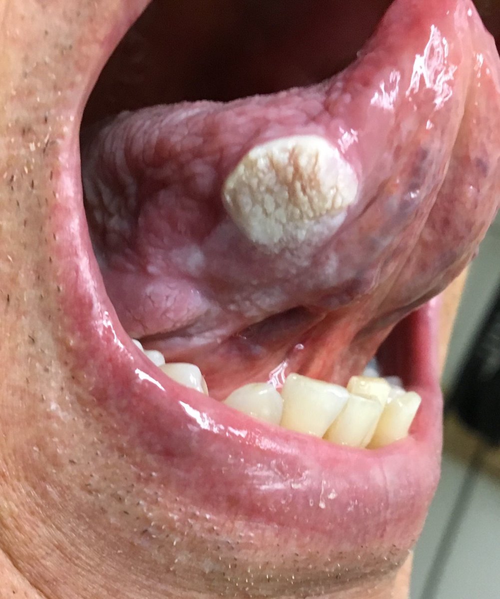 Md3ziz's tweet photo. Verrucous Carcinoma: is an uncommon variant of squamous cell carcinoma. seen in those who chew tobacco or use snuff orally, so much so that it is sometimes referred to as Snuff dipper's cancer.#made_easy #oralpath https://t.co/0mwd8keNMJ