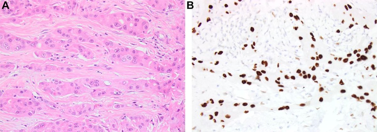 JClinPath_BMJ's tweet photo. In their second review of #apocrine breast lesions, D'Arcy and Quinn address invasive disease, the molecular apocrine signature and #immunohistochemistry https://t.co/OI8TtxT8nm #OnlineFirst #BreastPath #MolDx https://t.co/px6jeCC4Di