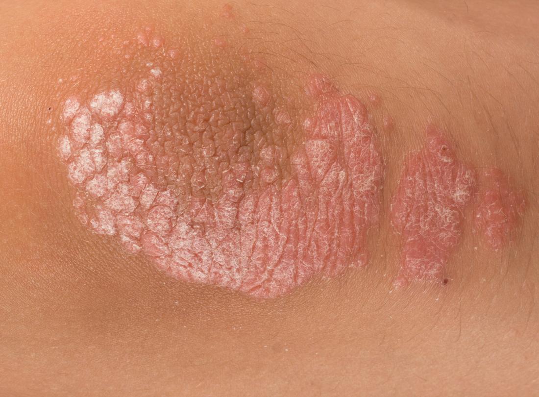 MNT_Yvette's tweet photo. What are the signs and symptoms of psoriasis? https://t.co/YCoAbhQ4bt @mnt_yvette https://t.co/DhWMv9UmLX