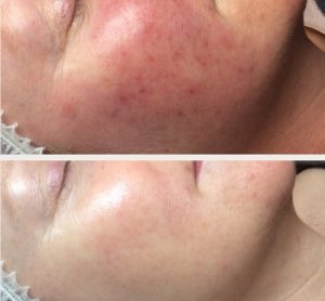 WxSkinClinic's tweet photo. Have you been diagnosed with Rosacea? Read this lady’s story here:  
https://t.co/weYI3mL2Ky 
#rosacea #Skin #skincare #skinhealth #skinclinic #resultsdriven #wexford https://t.co/sJ59JMuSNi