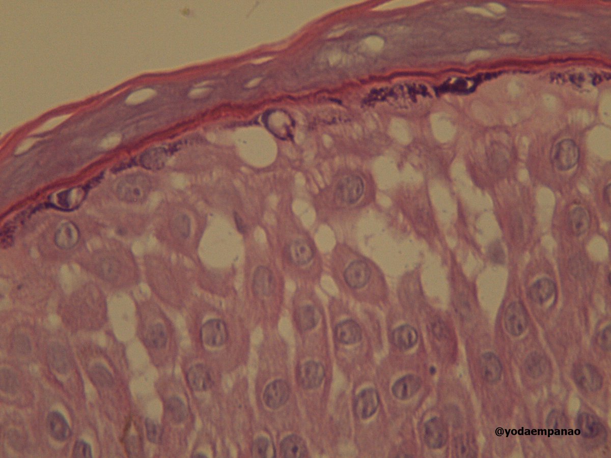yodaempanao's tweet photo. Do you think spongiosis will turn into a vesicle? #dermpath #dermapon @tlabiano @DraEosina @Edusco https://t.co/qoehAAEKLV