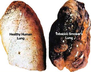 elfbar elfa master akku This is a comparison of what a healthy human lung looks like compared to a #smokers  lung. We want to help you quit #smoking by giving a free vape in order to #