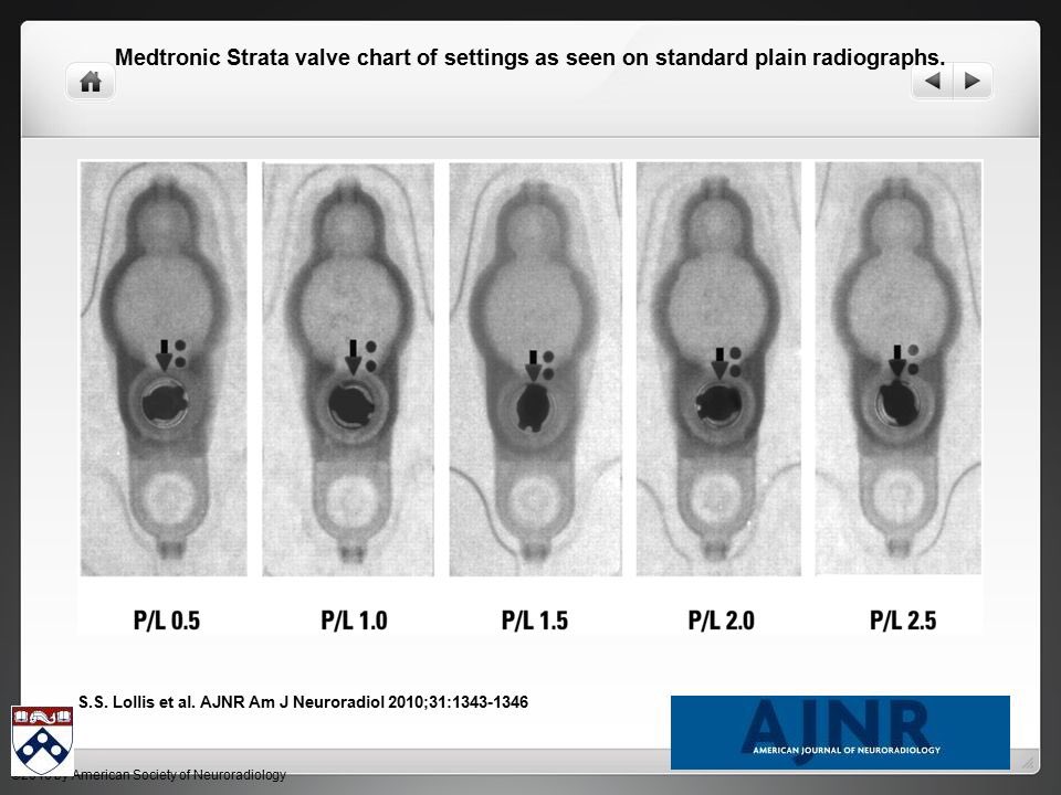 buchana_jab's tweet photo. Shunt rate...ever wonder...Benton & Simon school the attending #ThisisDenverEM #internpearl #FOAMed malfunctioning shunt-HA/N/V/AMS make sure to recheck rate after rapidMRI if programmable as MRI may erase programming. Involve NSG colleagues for ?s https://t.co/33BzO6Gh6l