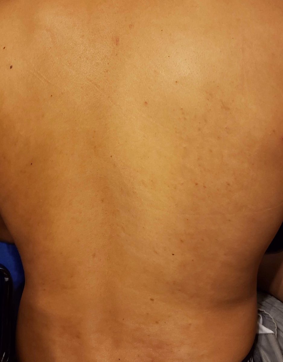 lauralazo66's tweet photo. Se confunde con la Pitiriasis Versicolor, piensas en una Pitiriasis Alba ,se hace KOH, biopsia ...y nada .......se indican todo tipo antifungicos   y nada ....
La hipomelanosis macular progresiva (HMP) es un trastorno adquirido de la pigmentación de la piel infradiagnosticado https://t.co/4o59vpHvIk
