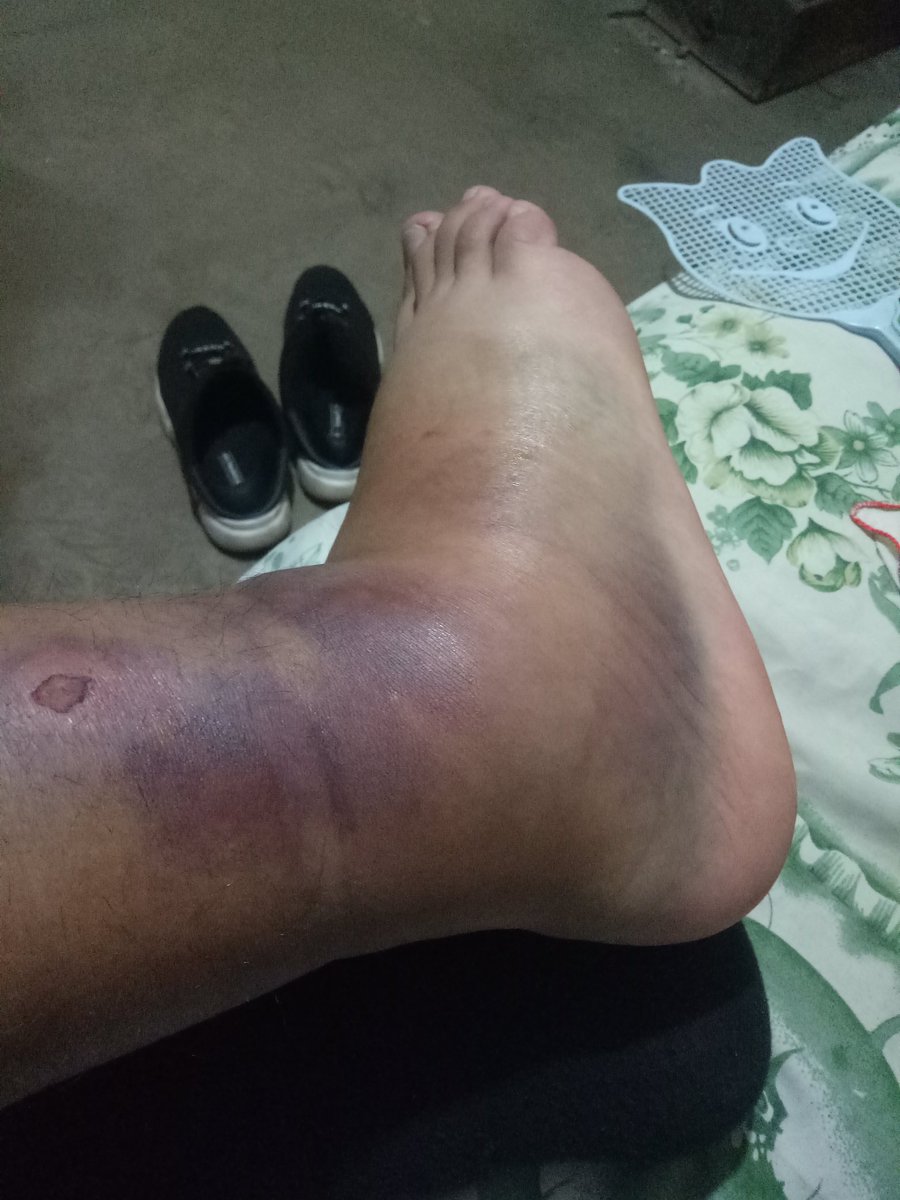 最近出了点事故，把脚伤着了