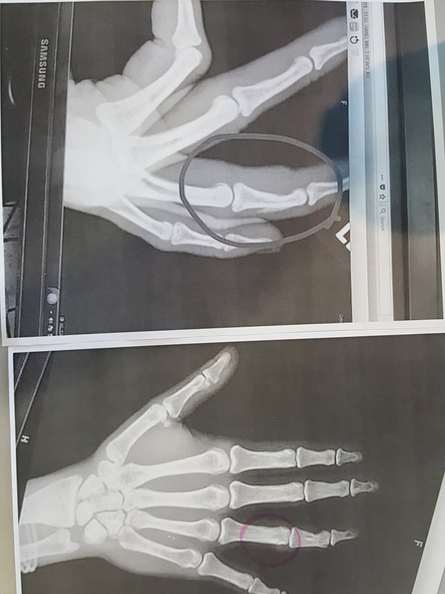 JaciBaxter's tweet photo. @ProsperRogersMS 

Cool radiology images.  swallowed quarter, swallowed marble and breaks of all shapes and sizes. https://t.co/UltiExp3RS