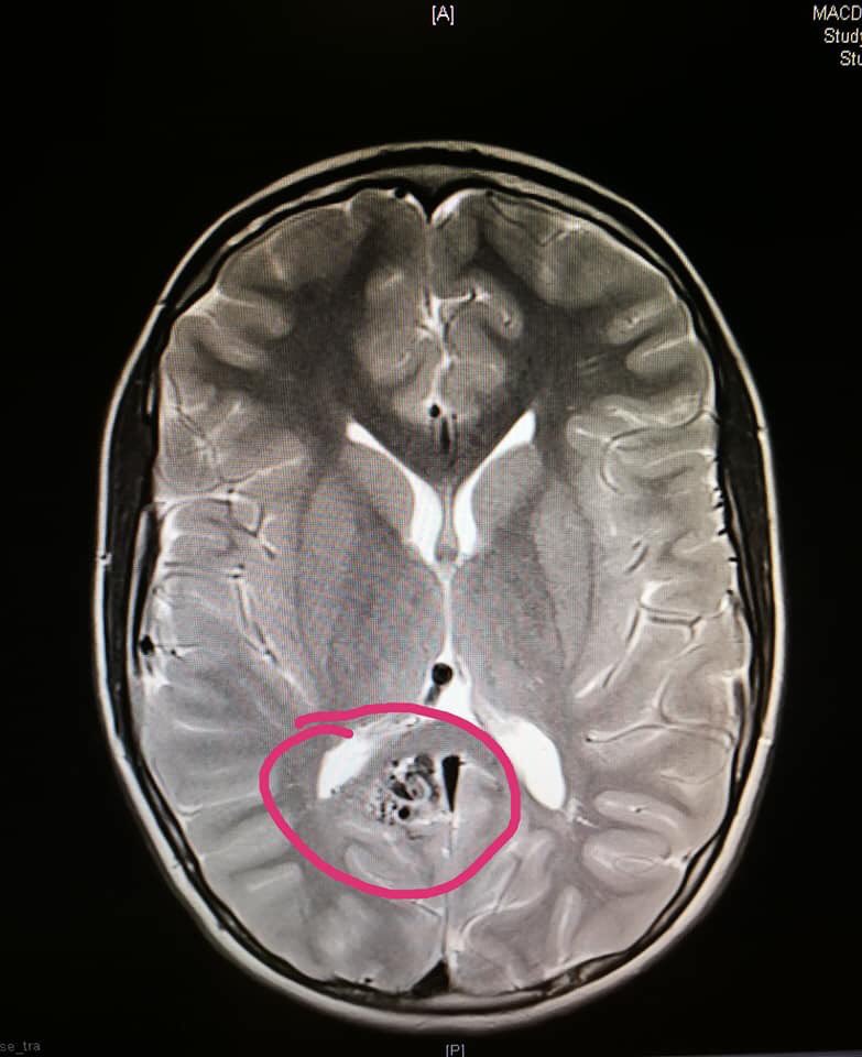 Mmegmac's tweet photo. When I was in secondary school I was teased for crying too much. At the time my brother was told he had an AVM in his brain and had to have surgery. Today he was told the mass in his brain has reduced massively. To those who made me feel weak, I am stronger now and my bro is too. https://t.co/PDRh7YQo7B