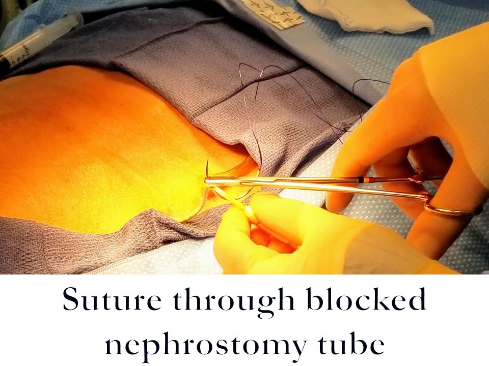 KevinRiceMD's tweet photo. How to exchange a blocked #nephrostomy tube. #FOAMIR @ajgunnmd @Drshiloh @rkryu @LessneVIR @keithppereira @JVIRmedia @MountSinaiIR https://t.co/RKOfFzVHi6