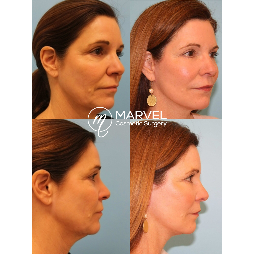 MarvelCosmetic's tweet photo. A Facelift tightens and lifts the skin around your face and neck. It also reduces fine lines and wrinkles, restoring your smooth and youthful skin. Learn more about facelifts by clicking the link below, then call 615-329-3900 to book your consultation! https://t.co/tkTDiXVw2B https://t.co/Py84CTYjA1
