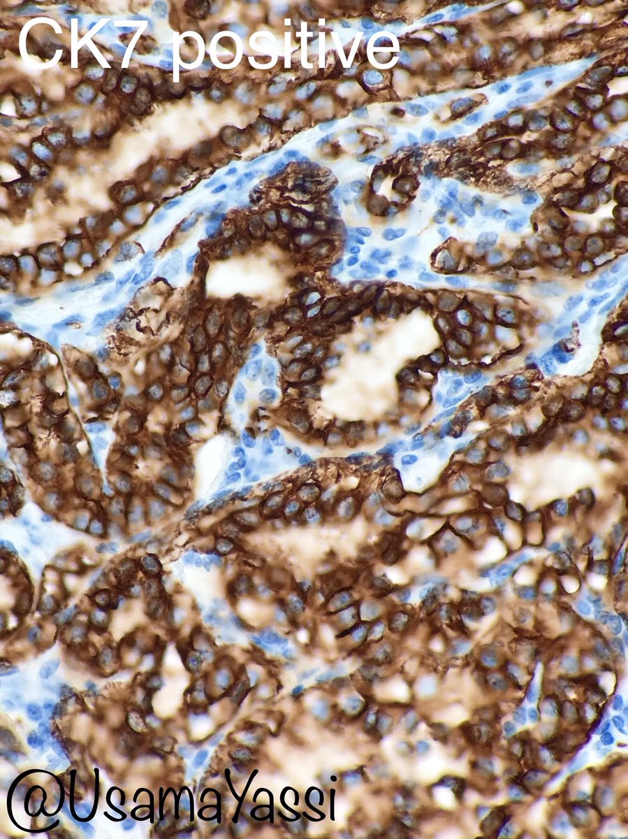 It’s a very nice case of Clear Cell Papillary RCC with clear cells with linearly-arranged low grade nuclei toward luminal surface in a tubular/acinar or papillary architecture. Cup-shaped CAIX &amp; CK7 positive. Can be associated with ESRD or sporadic. Indolent prognosis #GUpath