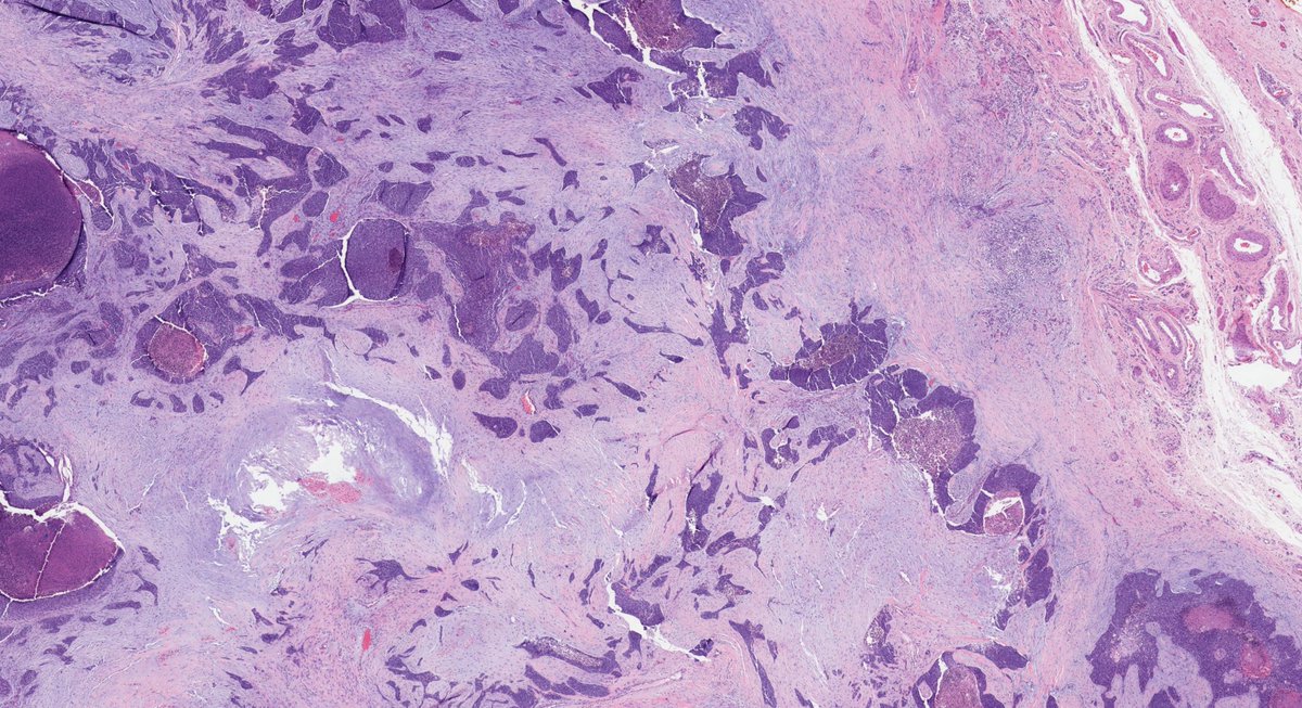 Andres_Matoso's tweet image. Usually located at the edge of the testis and displacing its parenchyma, metastatic tumors can mimic a primary testicular malignancy. This is an example of desmoplastic small round cell tumor (DSRCT). Confirmed EWSR1 FISH. @GUpath @urology