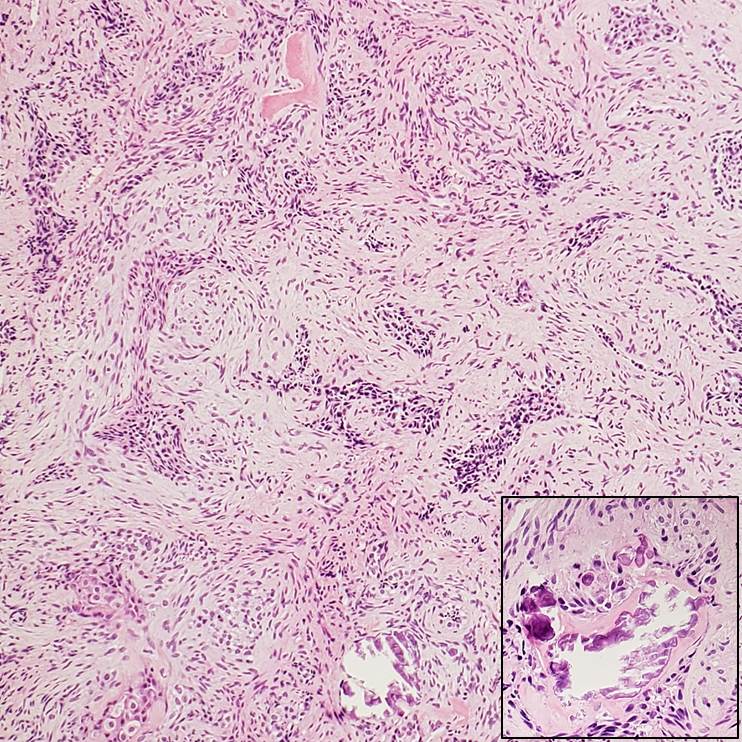 SamankanMD's tweet photo. 15 y/o F, right liver lobe mass 15cm
📍Nests of epithelioid spindle cell
📍Desmoplastic fibrotic stroma
📍Foci of calcification/ossification
📍Entrapped bile ducts
📍WT1 positive
✏Calcifying Nested Stromal Epithelial Tumor (CNSET) #GIpath #PediPath #Surgpath https://t.co/lGIRaOSJF9