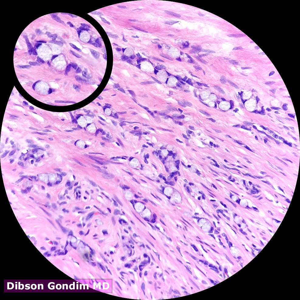 Appendix - Globlet Cell Carcinoid #GIpath <a href="/JMGardnerMD/">Jerad Gardner, MD</a> <a href="/luishcruzc/">Luis Humberto Cruz C</a> <a href="/NatashaRushPath/">Natalia Rush</a> <a href="/smlungpathguy/">Sanjay Mukhopadhyay</a> <a href="/slusagar/">Ankur Sangoi</a> @CArnold_GI @d_escobar_mdphd <a href="/Rus13Co/">CoRus13</a> <a href="/Path_Matt/">Matthew Cecchini MD PhD FRCPC</a> <a href="/LiveLovePath/">Samah Naderi, MD</a> <a href="/gonzadetoro/">Gonzalo De Toro</a> @Caldera60373705