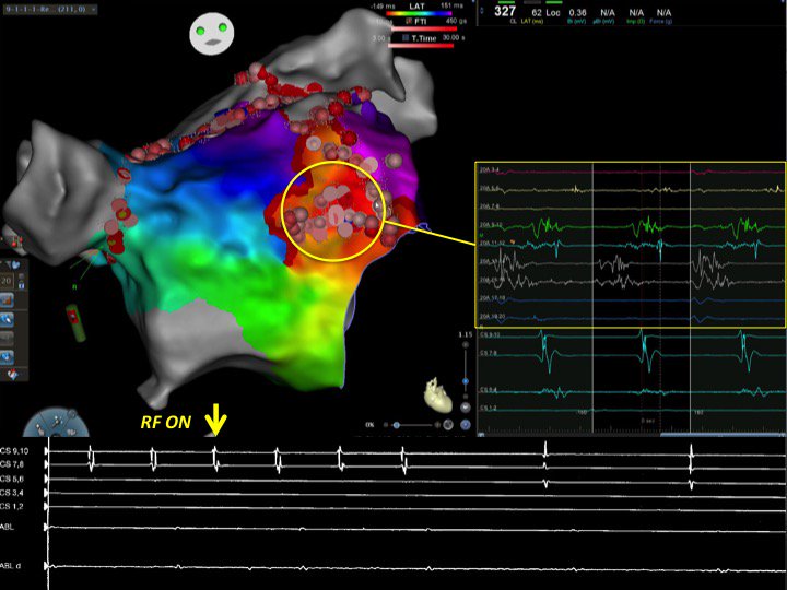 DrAJRestrepo's tweet image. Micro-reentrant AT in the anterior LA during persistent AF ablation following PVI, anterior mitral isthmus and roof lines. All EGMs of the Pentaray (yellow circle) encompass the TCL. Focal ablation in this area terminated the AT. #HowcoolisEP #HDmapping