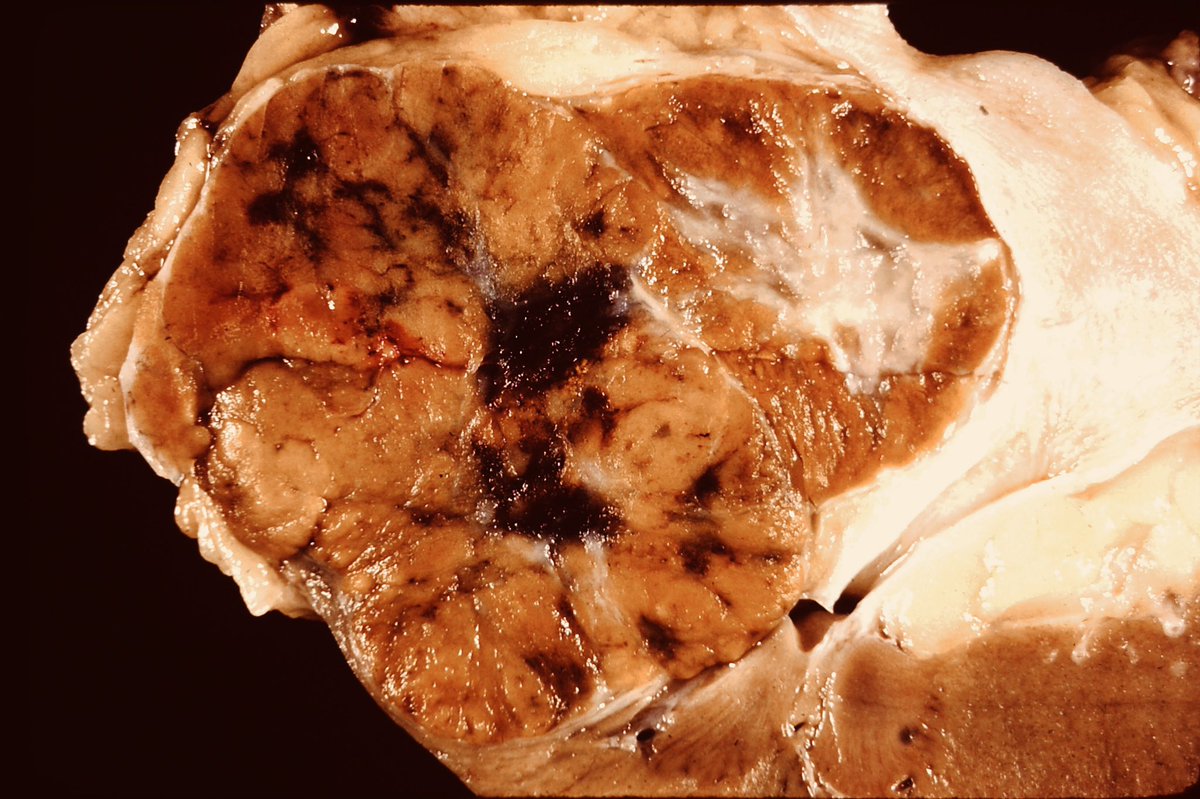 Sanjay Mukhopadhyay (@smlungpathguy) on Twitter photo If you want to take good macroscopic pictures that are suitable for publication, the background MUST be clean. It takes time, but it’s worth it. Pic: renal cell carcinoma. Another tip: put lesion in center.
Pics courtesy of <a href="/yro854/">Yale Rosen</a> #yalerosenslidecollection #GUpath #grosspath If you want to take good macroscopic pictures that are suitable for publication, the background MUST be clean. It takes time, but it’s worth it. Pic: renal cell carcinoma. Another tip: put lesion in center.
Pics courtesy of <a href="/yro854/">Yale Rosen</a> #yalerosenslidecollection #GUpath #grosspath