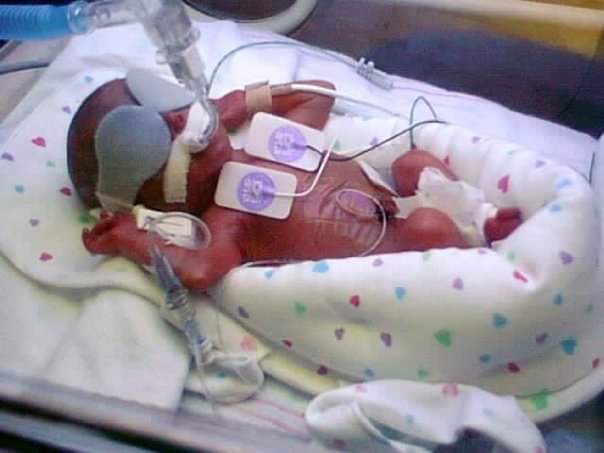 HydroMama's tweet photo. #WorldPrematurityDay, I’m raising awareness about Posthemorrhagic #hydrocephalus (PHH), which most often occurs in premature infants. #preemiehydrohero
I join @HydroAssoc in calling for more research dollars to find a cure and prevent PHH. Learn more at: https://t.co/zC5yHdIgmB. https://t.co/yesrYg4Y55