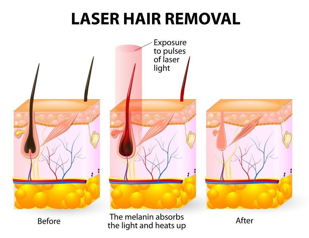 NewOrchidWC's tweet photo. DO YOU WANT TO BE HAIR FREE NEXT SUMMER? 🙌🏼
•
IPL - HAIR REDUCTION💥
•
To book a free consultation with Lindsay call 
📞01438 815151
#IPL #Ellipse #HairReduction #PermanentHairReduction https://t.co/MMN0D8u7V6