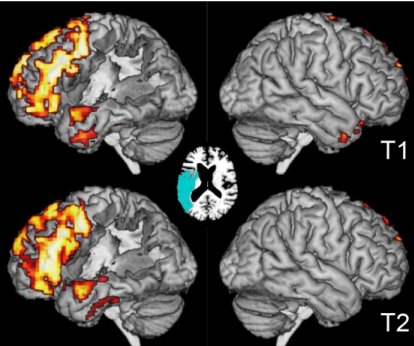 Stephen Wilson (@smwilsonau) on Twitter photo At 8am I'll be presenting our work on language mapping in aphasia as part of the ASHA Research Symposium. #asha2018 #asha18 <a href="/AphasiaLab/">Center for Brain Recovery</a> asha.org/Research/Resea… At 8am I'll be presenting our work on language mapping in aphasia as part of the ASHA Research Symposium. #asha2018 #asha18 <a href="/AphasiaLab/">Center for Brain Recovery</a> asha.org/Research/Resea…