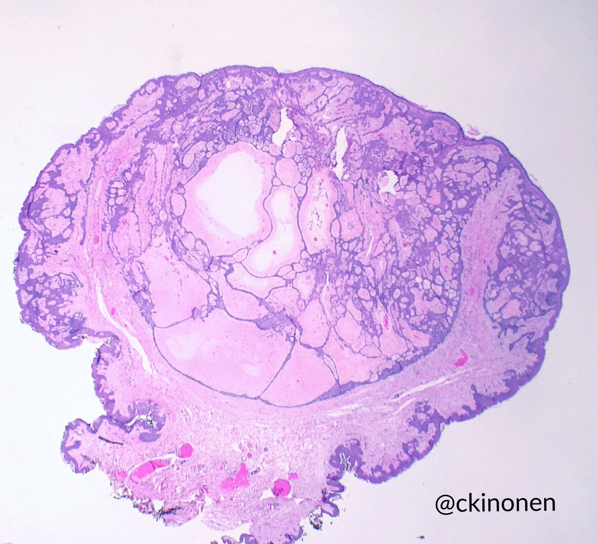 ckinonen's tweet image. Fibroepithelioma of Pinkus, basal cell carcinoma fibroepithelioma type, Pinkus tumor, new WHO (4th edition) calls it fibroepithelial basal cell carcinoma. Whatever your preferred name, it&apos;s a pretty tumor. #pathology #dermpath