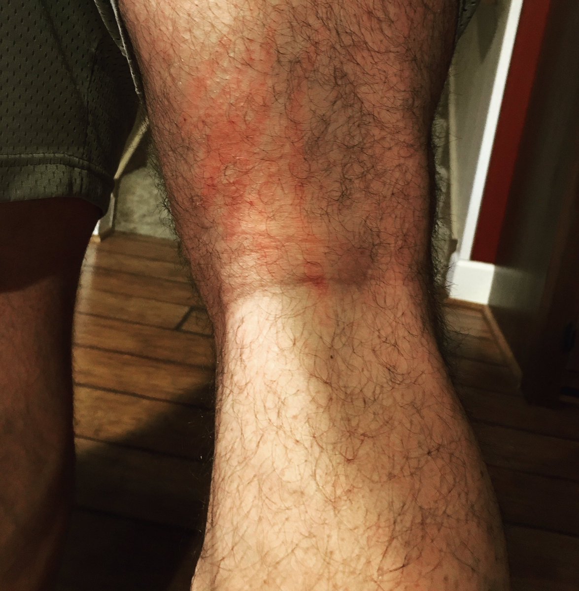 DoogsScents's tweet photo. Update from last night!! After all the base layers came off the wife checked my leg and this is the result of the #bellwitch #attic #hauntedlive Thanks for the massive amount of messages concerning my safety after this crazy #episode https://t.co/dVJ9N4vYdK