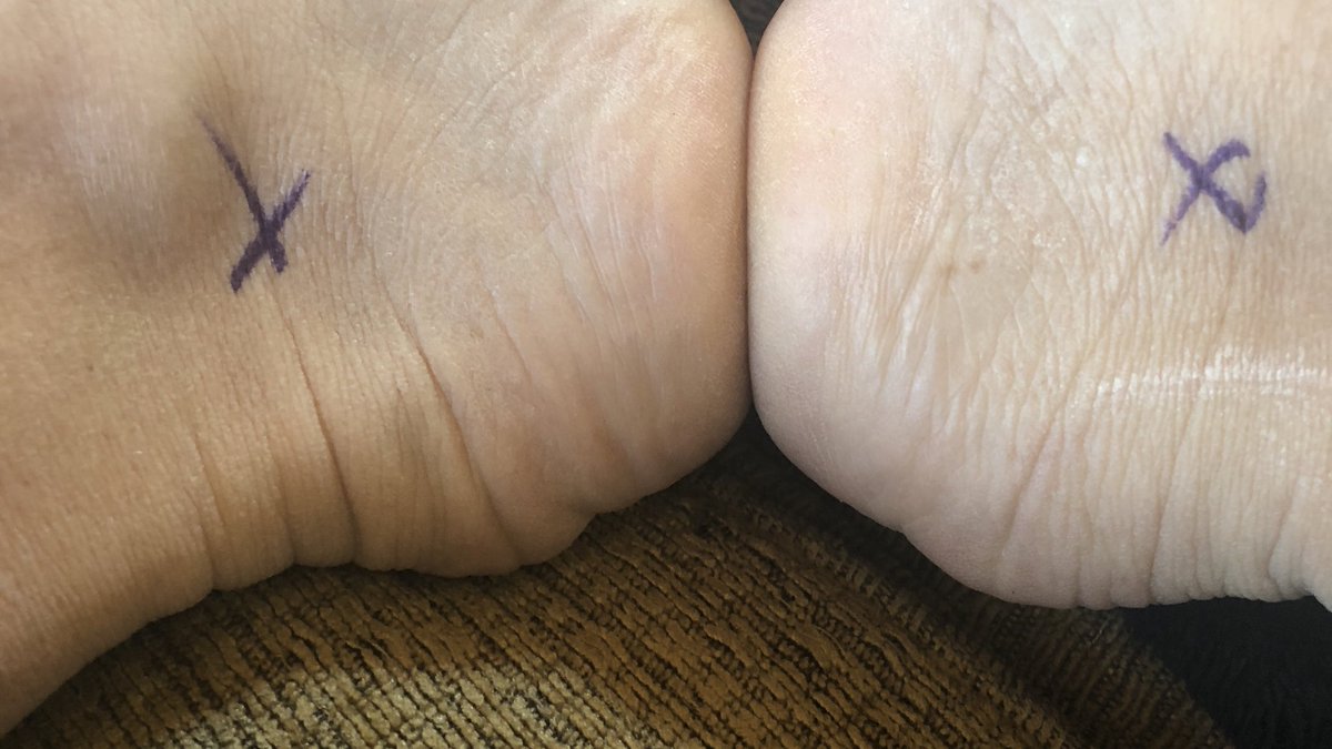 radiolawtalk's tweet photo. Great show by my co-hosts and producer. Can’t find talet that good! Thank you. Getting better yes this is from a surgery they mark your feet. Haha. #podcast #surgery #resting #neededrest #DoctorDoctor #doctororders #radiohost #funny https://t.co/kLyoCs1DQL