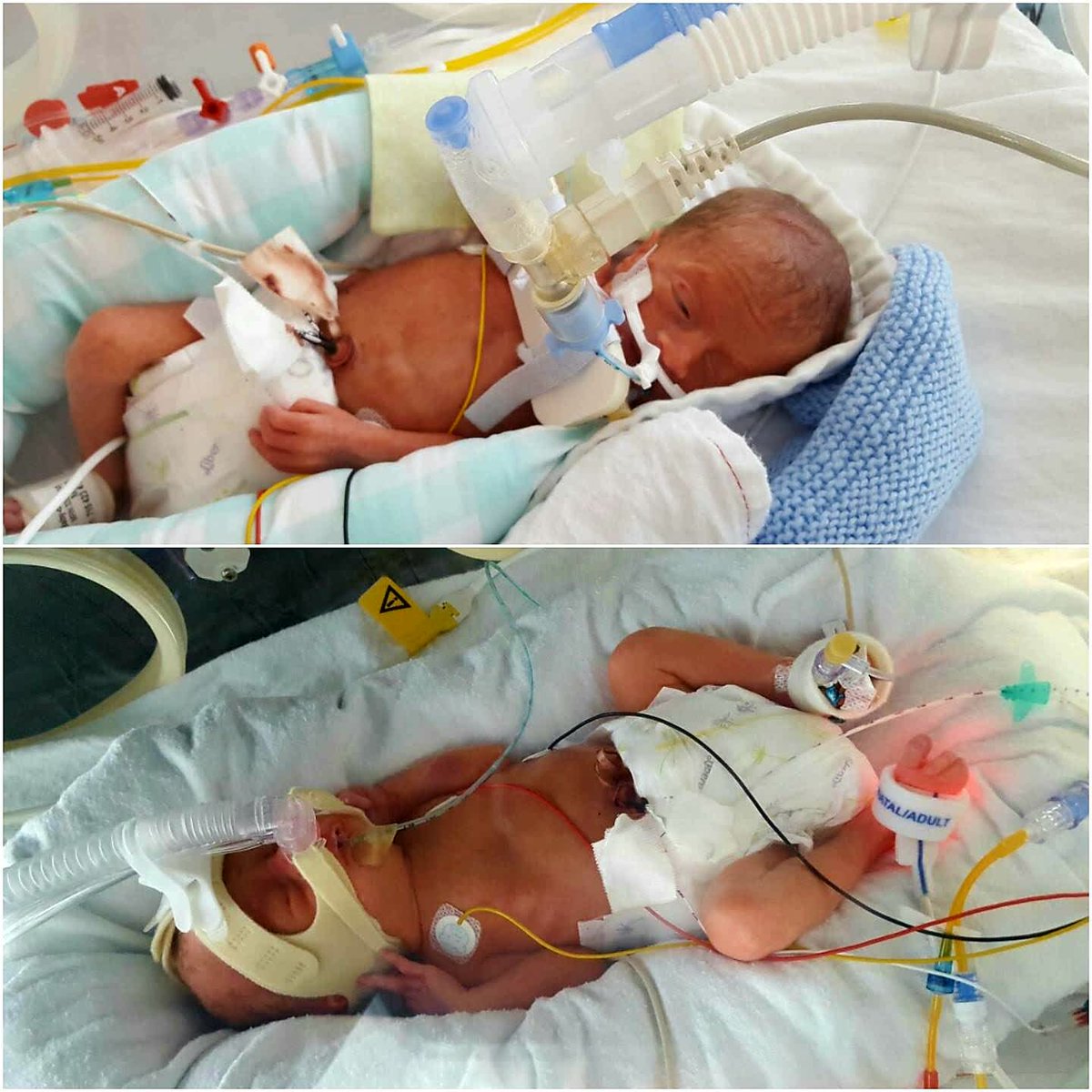 ollie_tate's tweet photo. #WorldPrematurityDay @Blisscharity @tamba_twins_mb amazing how strong they become after a tough start #28weekers https://t.co/6TqXuwDSh0