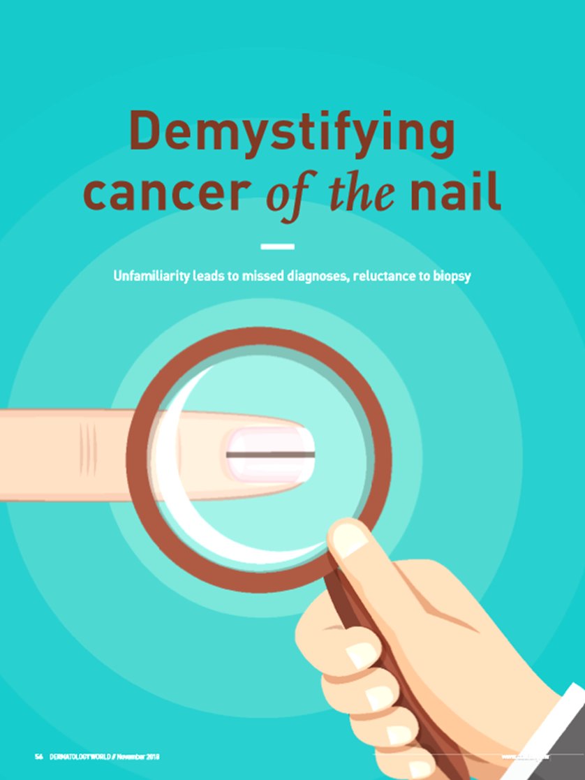 AADmember's tweet photo. You can’t trust the #nail...this month’s issue of #DermWorld demystifies cancer of the nail. https://t.co/la5tvhCJLK / #nailcancer @adamirubin @DrDanaBeauty https://t.co/gdAmX1zmUa