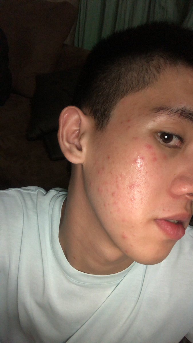 Recyclevin_'s tweet photo. RT for Clear skin or else balakayojan. ✨ https://t.co/IawSOBfZPt