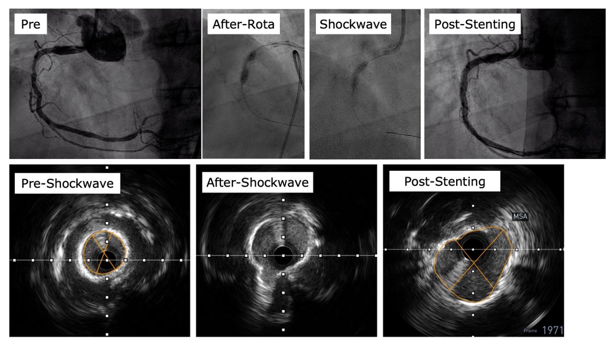 vinvizzi's tweet image. Amazing @ShockwaveIVL case @ Luigi Sacco Hospital, Milan with #MaurizioDiBiasi. Previously failed PCI to RCA despite #rotablator. 8 IVL inflations, calcium cracked, stenting and job done. Quick, effective, safe. Impressive.