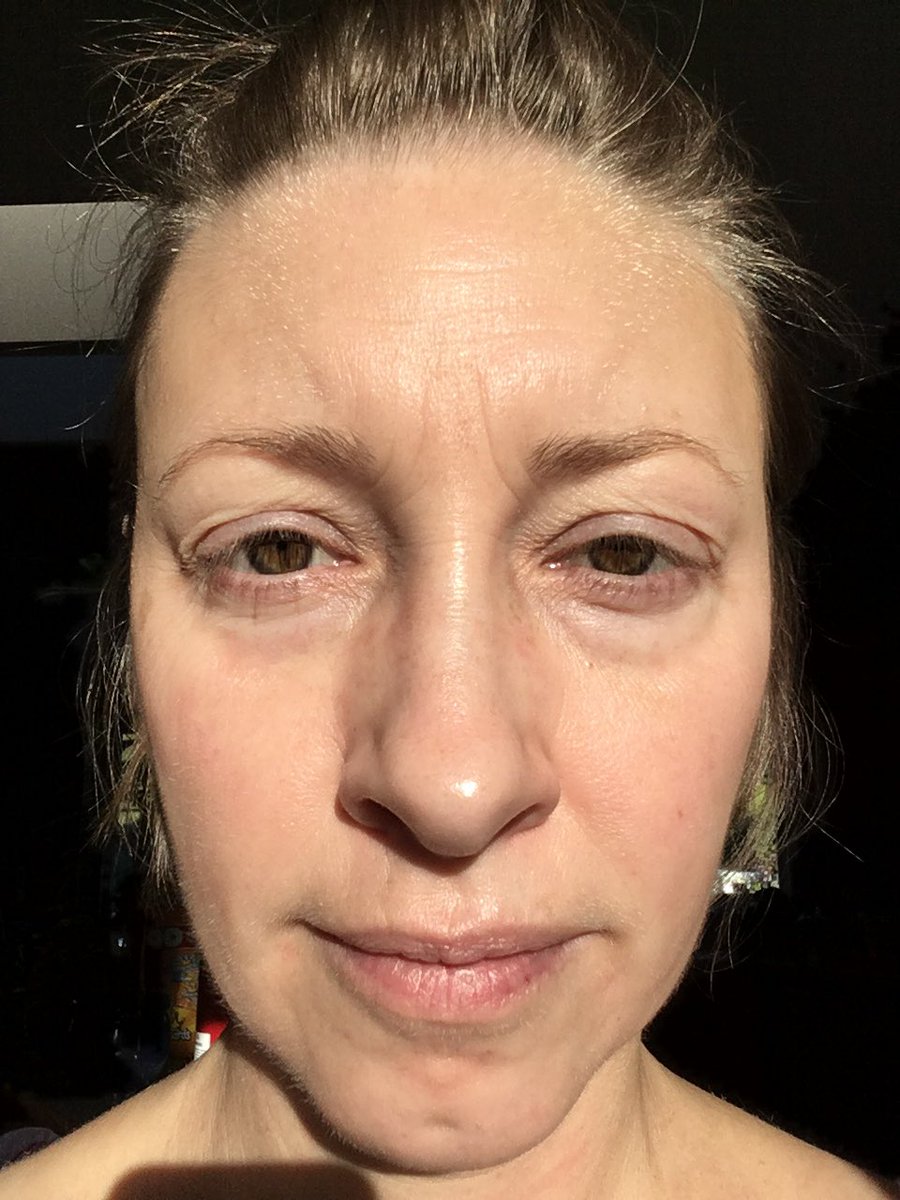 Rhiannon Ryder on X: Three weeks into the Reverse regimen and sooo much of  my sun damage is ALREADY melting away! #RodanAndFields #greatskin #40  t.coWdk81rWDQA  X