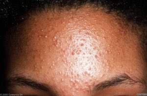 Mai в Twitter: "Tiny bumps on forehead - doesn’t seem popable , they are not exactly whitehead but kinda itchy and acne treatment product doesn’t seem to work, high chances you might be struggling with Fungal Acne a.k.a Malassezia Folliculitis.