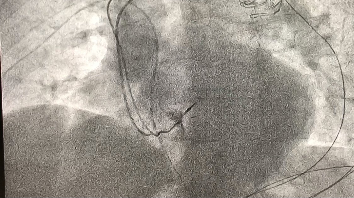 Sunday special ! CHB with RBB escape. Deep septal pacing with LBB capture. Yes ... we keep evolving from HIS pacing. Thx Dr Huang and Dr Vijayraman for their amazing education in this space. Great people !