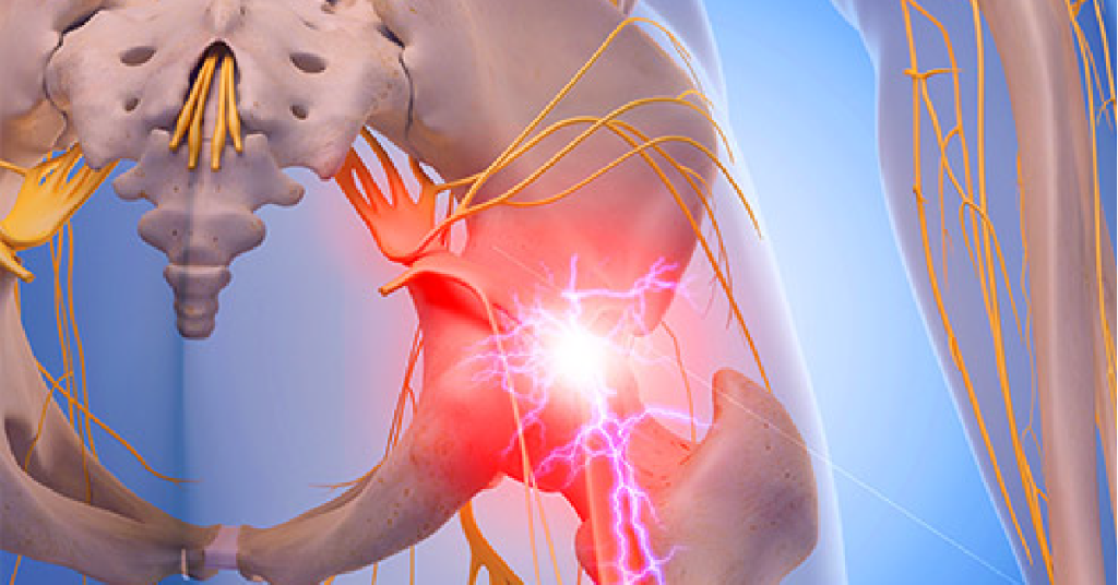WebMD's tweet photo. Too much sitting and too little exercise, among other things, can irritate and inflame your sciatic nerve -- causing hip and leg pain. https://t.co/1WJe3TF04v https://t.co/uV2DbGENcP
