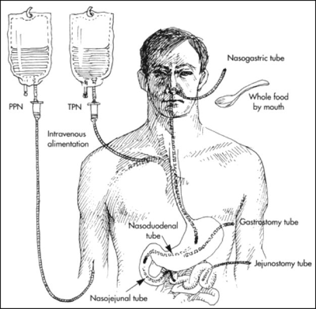 Total Parenteral Nutrition total-parenteral-nutrition