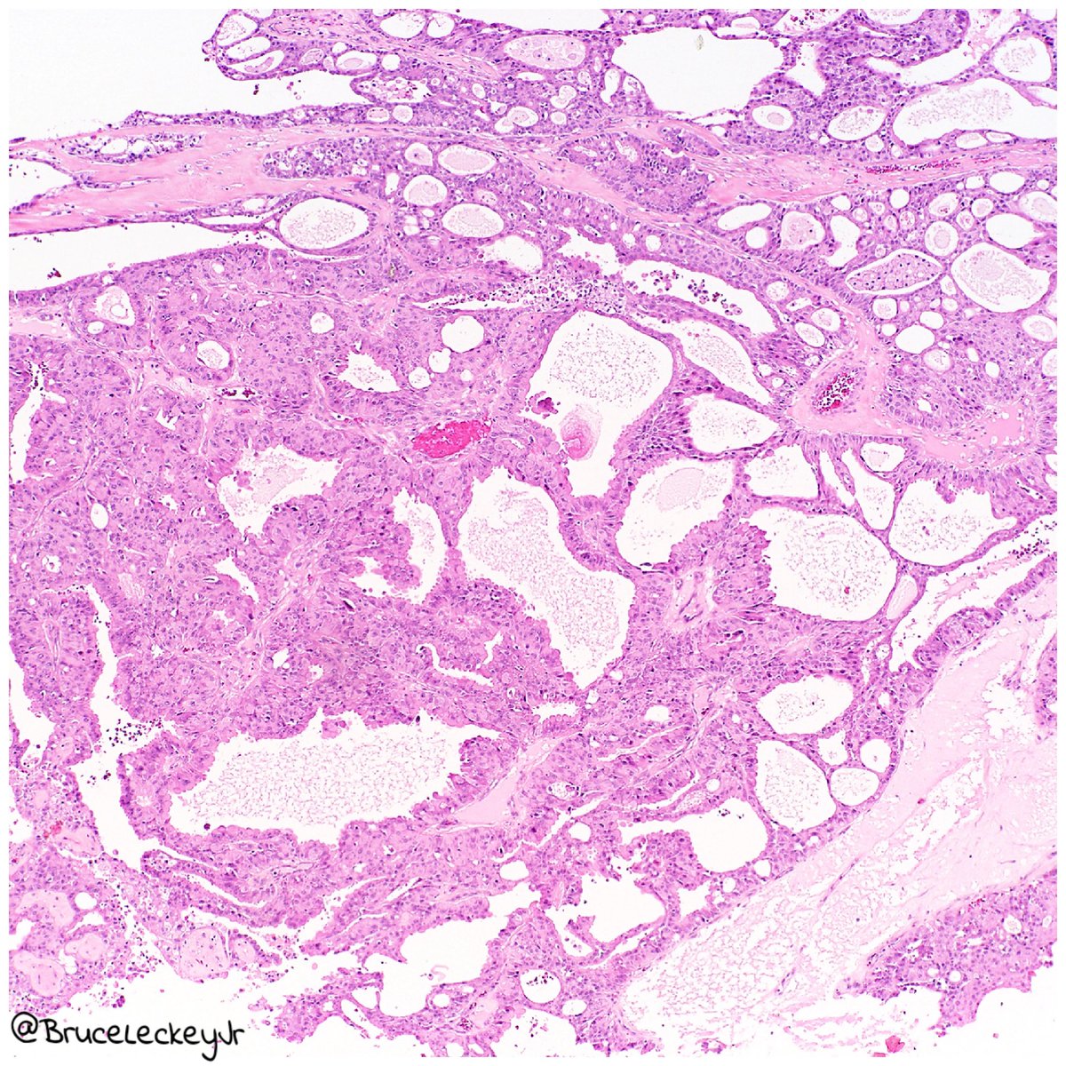 BruceLeckeyJr's tweet photo. In case you missed it at #asdp2018 Vulvar apocrine adenocarcinoma. #pathology #dermpath https://t.co/Svyhm66h2C