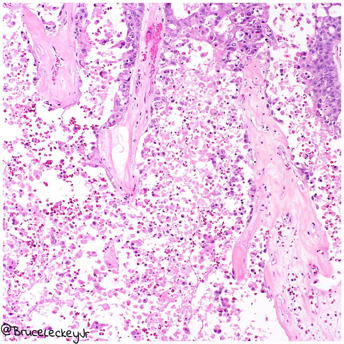 BruceLeckeyJr's tweet photo. In case you missed it at #asdp2018 Vulvar apocrine adenocarcinoma. #pathology #dermpath https://t.co/Svyhm66h2C