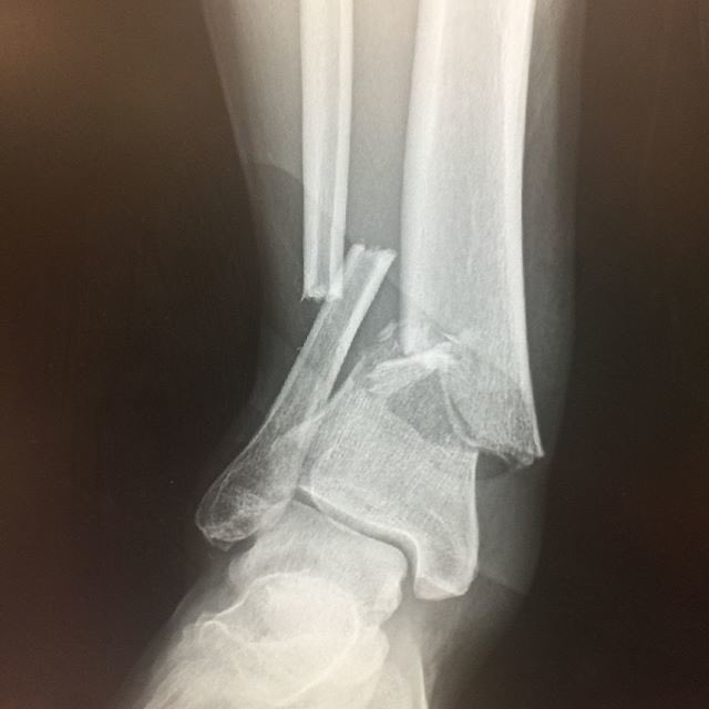 SeretisCare's tweet image. Tibial &amp;amp; Fibular Fractures of the lower leg / ankle are severe injuries typically resulting from high impact mechanism injuries or trauma as seen earlier today to @Redskins QB #AlexSmith &amp;amp; often referred to as #TibFib fracture