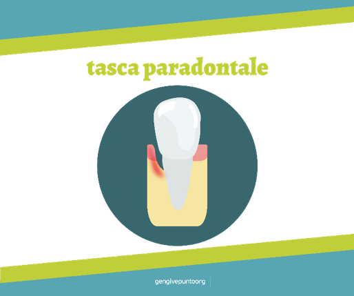 A causa dei depositi di placca il solco gengivale può aumentare la propria profondità, formando una tasca chiamata tasca parodontale. Scopri come evitarle gengive.org/glossario/tasc… #prevenzione