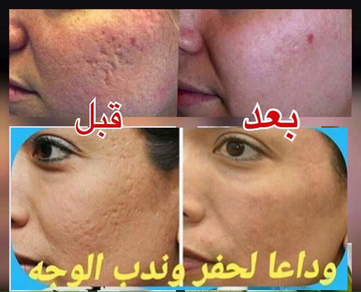 Forever19166350's tweet image. وداعا للحفر والندوب بالبشرة وتمتعي ببشرة صافية وناعمة مع منتجات عالمية امريكية *الامانة شعارنا*#السعودية #المملكة #اليمن_في_قلب_السعودية #الا_السعوديه #محمد_بن_سلمان_انت_في_قلوبنا #تبوك_ترحب_بالملك_سلمان #اليوم_الوطني_العماني_48 #قانون_الضريبة #سعوديات_نطلب_اسقاط_الولايه862