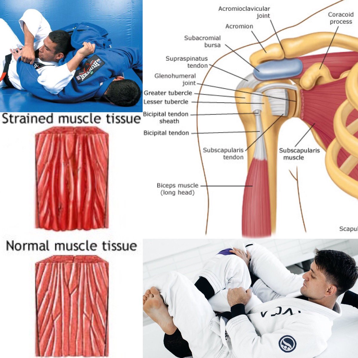 medjitsu's tweet photo. Medjitsu Joint series Part 1.3
Overuse and strain can lead to injuries such as..................... click link for full post https://t.co/JHQ37bCU0B  #sportsmedicine #ufc #mma #mixedmartialarts #shoulderinjury #Orthopaedic #medicine #bjj #brazilianjiujitsulifestyle #bjj4life https://t.co/bpYO6tzjPs