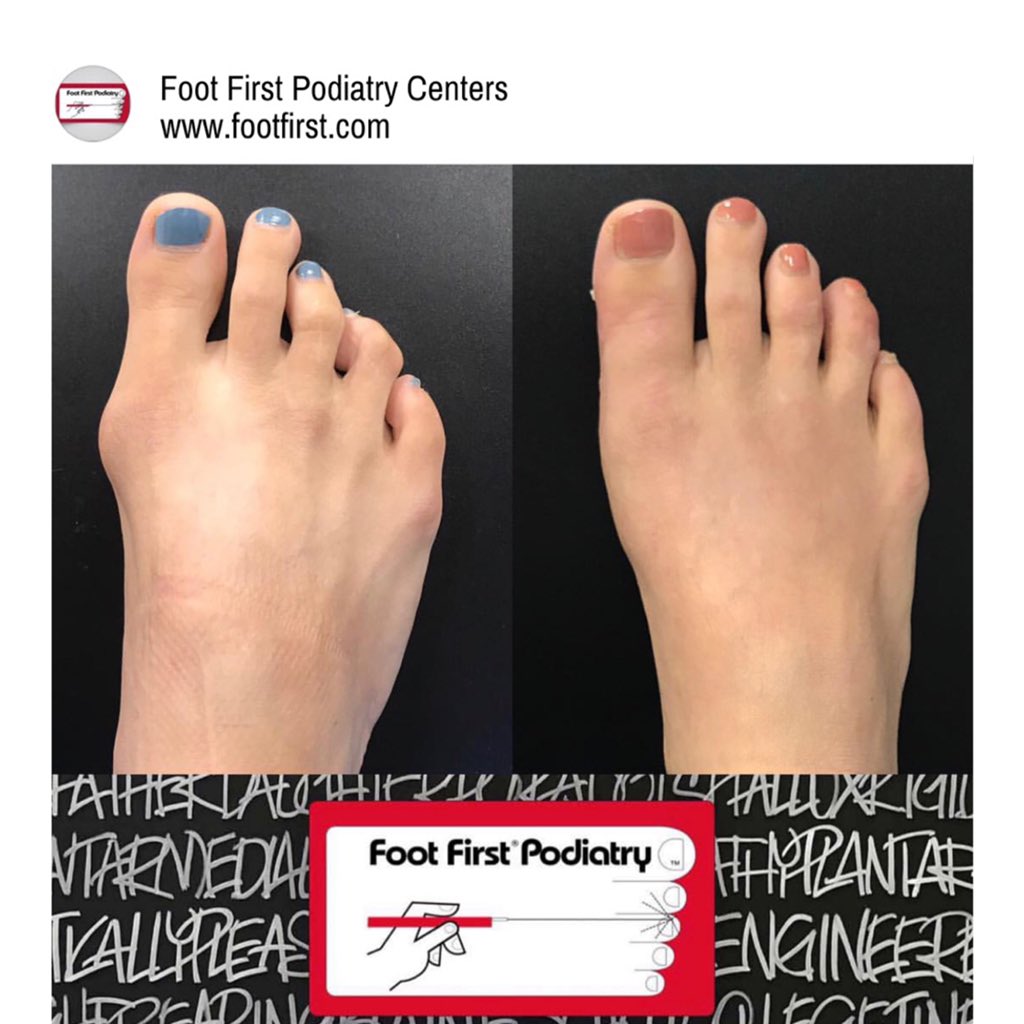 foot1st's tweet photo. Some people are #blessed with healing beautifully. Don’t you just hate this patient who is only 6 weeks post #bunion and #hammertoe surgery 😝 https://t.co/kEdHzxayKs