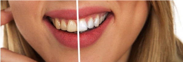 SmilEssentials's tweet photo. The holiday season is right around the corner! Make sure your smile is photo ready by having your teeth professionally whitened. To learn more and make an appointment, visit: https://t.co/mXyndQHzXj https://t.co/EVfkhj52Z5