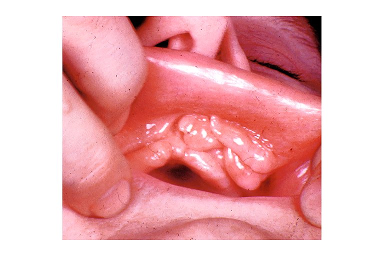 ReemAlhoqail's tweet photo. Epulis fissuratum is an oral pathologic condition that appears in the mouth as an overgrowth of fibrous connective tissue. It is associated with the edges of a denture that does not fit well. #OralPath #Made_easy https://t.co/jiZPEnQt8c