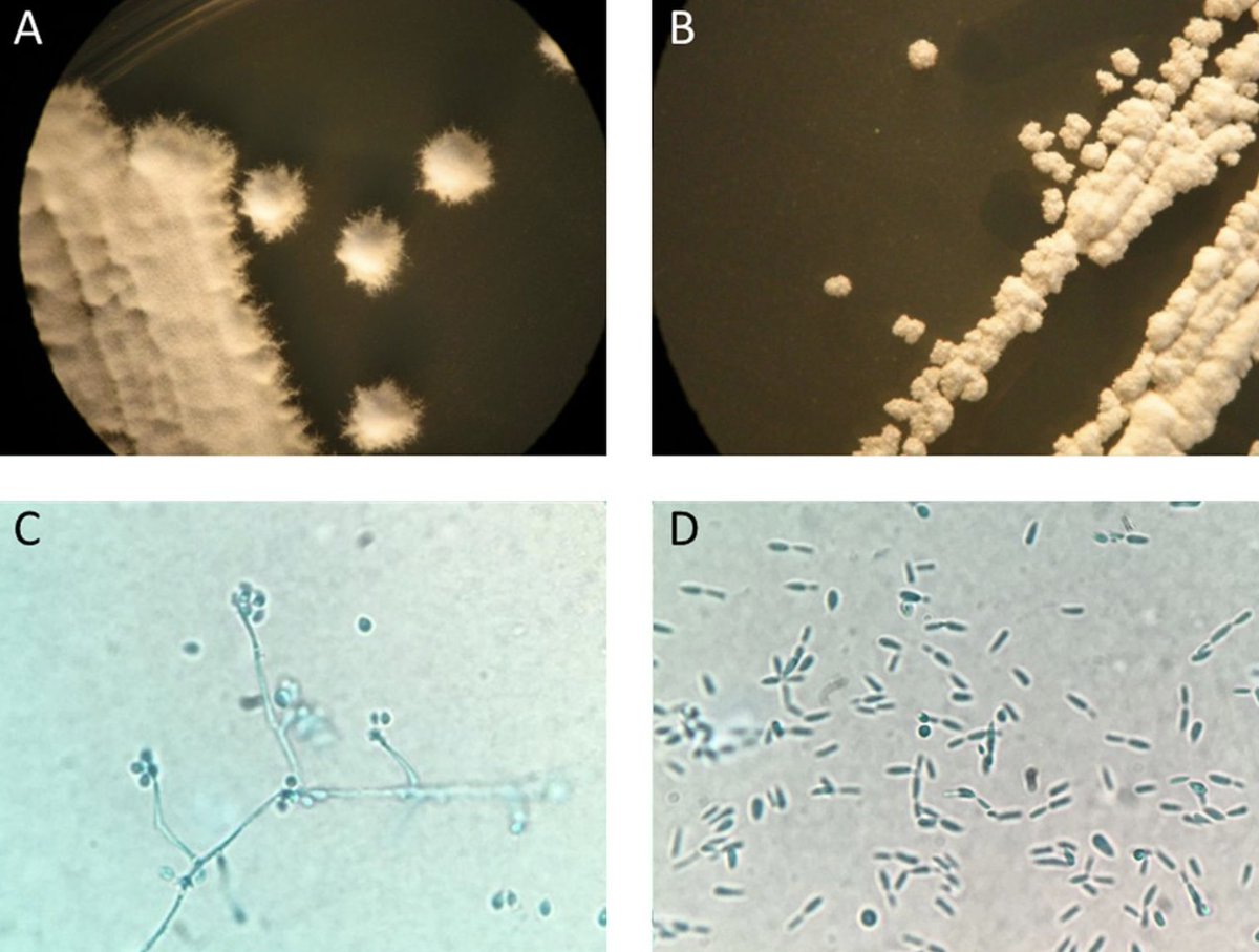 November Brief Case: Cutaneous sporotrichosis in an immunocompetent patient after travel to Peru <a href="/JClinMicro/">JClinMicro EIC</a> ow.ly/w8ub30mCnwh #ASMClinMicro