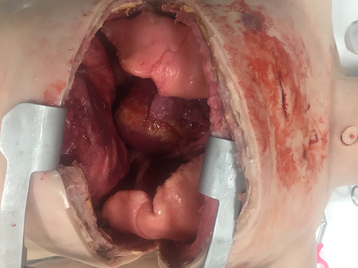 EshtResus's tweet photo. ⁦@danielle_vidler⁩ ⁦@markedwards999⁩ ⁦@drswalton⁩ ⁦@Prometheusmed⁩ ⁦@ESHT_ESME⁩ superb realism on this mannikin best thing ive ever seen! #traumaticarrest hopefully coming to ESHT soon ⁦@Friends_DGH⁩ #simtraining https://t.co/J3zhlbUmUq