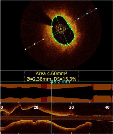 CRMjournal's tweet photo. #Occult #hemodynamically #significant #LeftMain #stenosis in #asymptomatic #patient: Reconciling Visual-Functional #Mismatch by Maryam Balouch, Jennifer Ballard-Hernandez, Min Kim, @arnoldseto and @drmortkern https://t.co/w34o55uKWH in Oct/Nov issue https://t.co/LEFzelTFsg