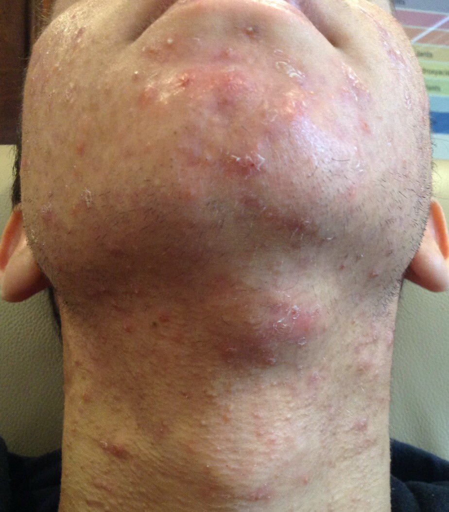 SkinHappyMD's tweet photo. Here is a before and after of one of our patients! His acne cleared up in just 4 months using Dr. Kenner's topical treatments. #monterey #carmel #skincare #beauty #confidence #skinhappymd #happyskin #acnetips #JKbackground #DidYouKnow #skinjourneys #healthandbeautytips https://t.co/Z2FWXy6gtf