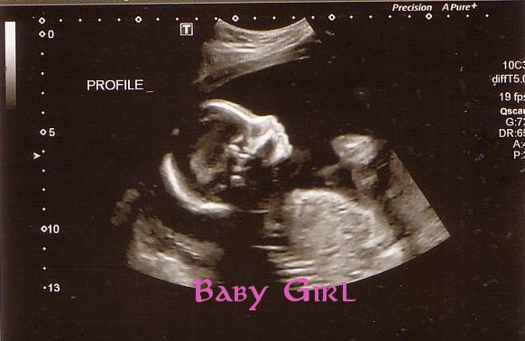 [ Starter for <a href="/EddardS33453166/">Eddard Stark</a> ]

Lynsey went to her first doctors appointment and found the gender the of their baby and to her surprise it was their little Lynsey Claude Stark